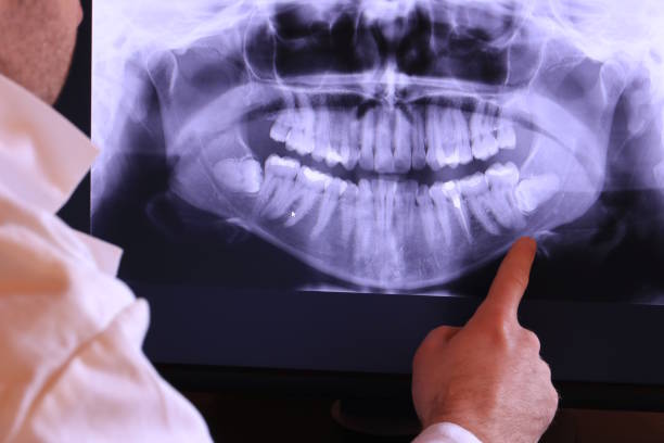 Best Knocked-Out Tooth (Avulsed Tooth) Treatment in Kana, UT